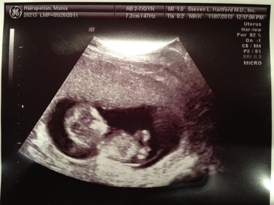 Baby-Ultrasound